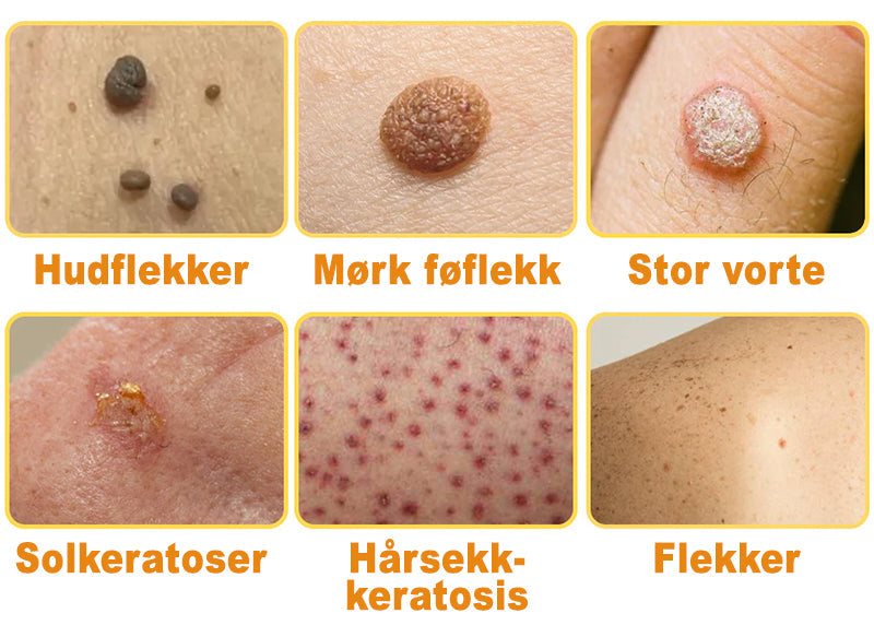 🦍Turoment™ Bie Gift Behandlingskrem (🔥Siste dag, 80 % rabatt)