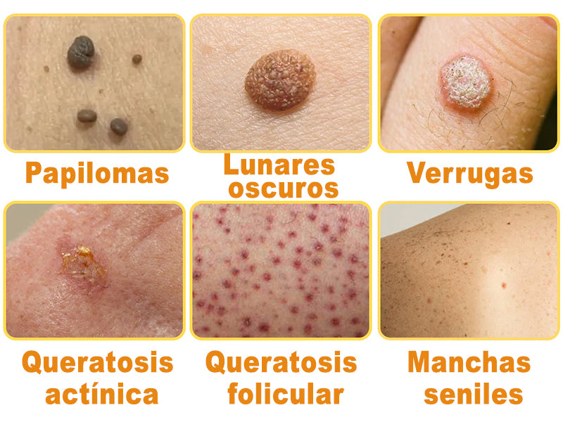 🦜Turonu™ Crema de Tratamiento con Veneno de Abeja (🔥Último día, 80 % de descuento)