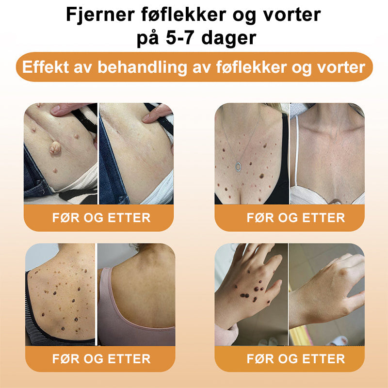 🦍Turoment™ Bie Gift Behandlingskrem (🔥Siste dag, 80 % rabatt)