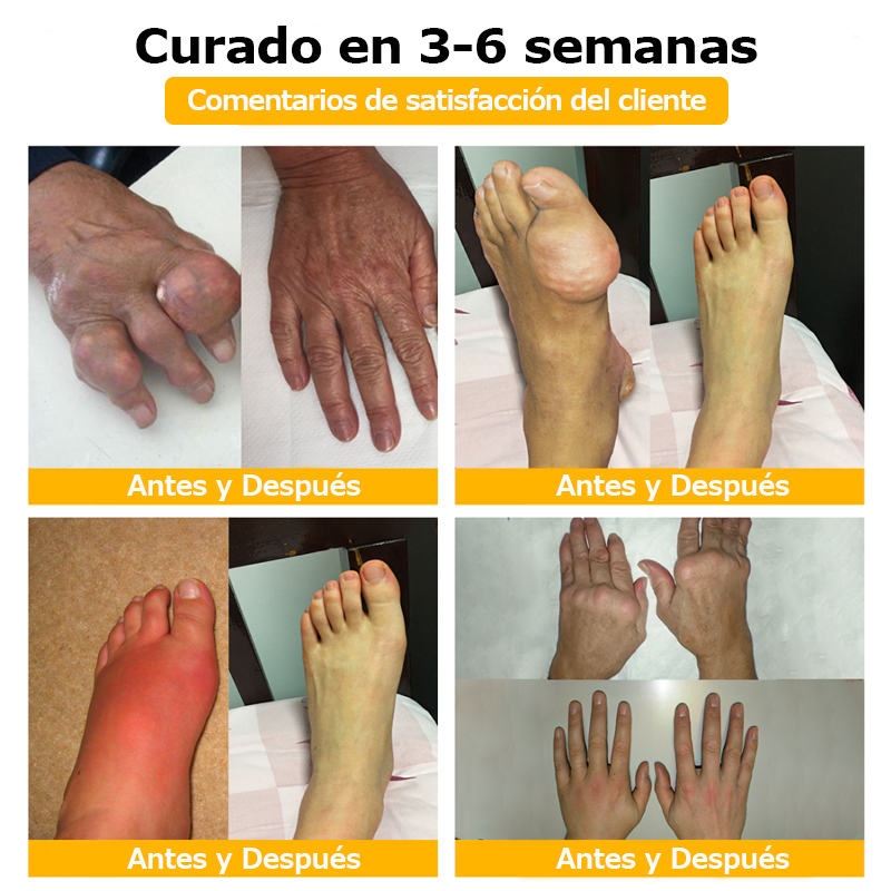 🧶Furzero™ Crema de Veneno de Abeja para Articulaciones y Huesos (✨ Especialmente para condiciones ortopédicas y dolor articular ✨)