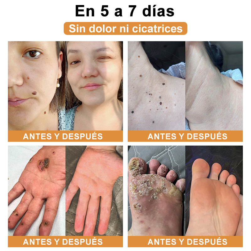 🦜Turonu™ Crema de Tratamiento con Veneno de Abeja (🔥Último día, 80 % de descuento)