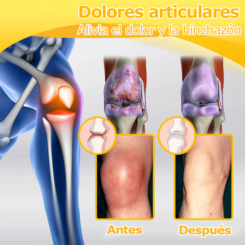 🧶Furzero™ Crema de Veneno de Abeja para Articulaciones y Huesos (✨ Especialmente para condiciones ortopédicas y dolor articular ✨)