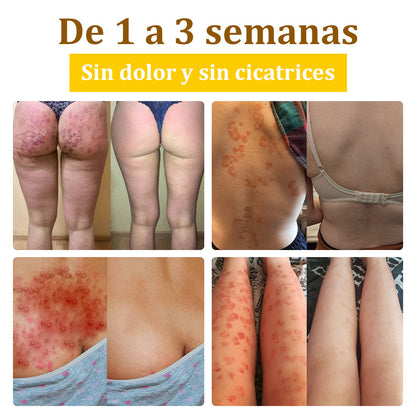 ✅Crema de tratamiento con veneno de abeja flysmus™🐝: Para Eczema, Psoriasis, Acné, Rosácea, Infecciones por Hongos, Verrugas