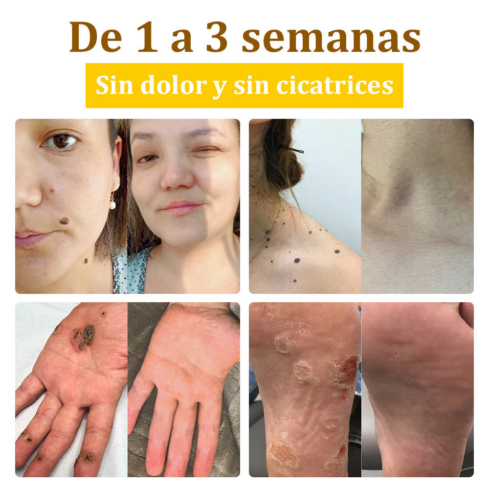 ✅Crema de tratamiento con veneno de abeja flysmus™🐝: Para Eczema, Psoriasis, Acné, Rosácea, Infecciones por Hongos, Verrugas