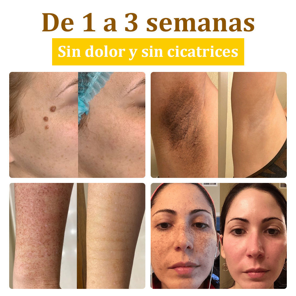 ✅Crema de tratamiento con veneno de abeja flysmus™🐝: Para Eczema, Psoriasis, Acné, Rosácea, Infecciones por Hongos, Verrugas