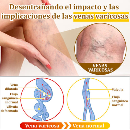 ✅Crema de tratamiento con veneno de abeja flysmus™🐝: Para Eczema, Psoriasis, Acné, Rosácea, Infecciones por Hongos, Verrugas