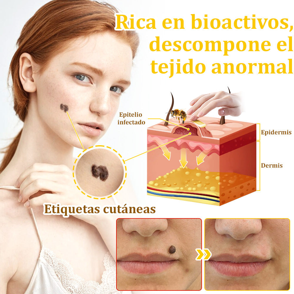 ✅Crema de tratamiento con veneno de abeja flysmus™🐝: Para Eczema, Psoriasis, Acné, Rosácea, Infecciones por Hongos, Verrugas