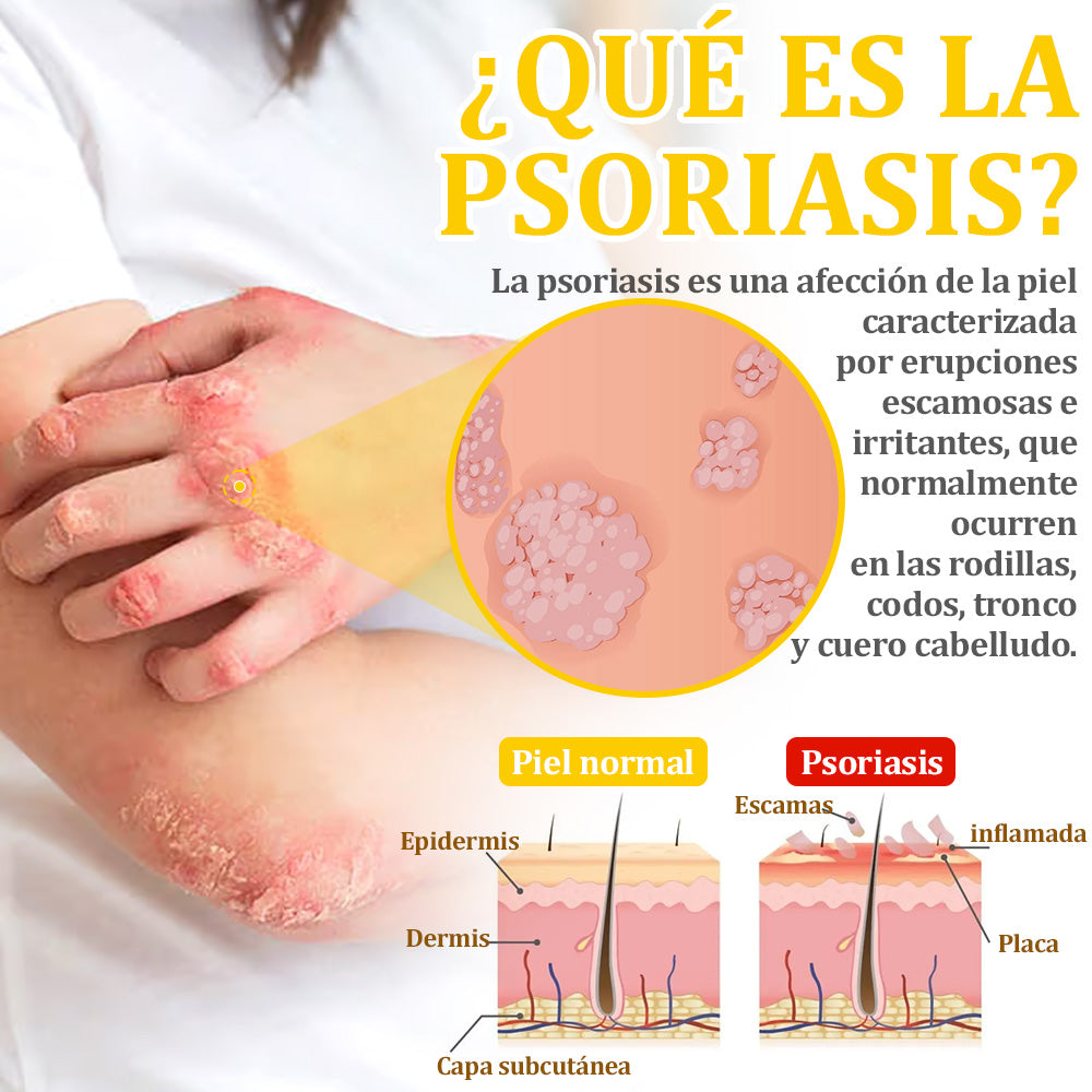 ✅Crema de tratamiento con veneno de abeja flysmus™🐝: Para Eczema, Psoriasis, Acné, Rosácea, Infecciones por Hongos, Verrugas